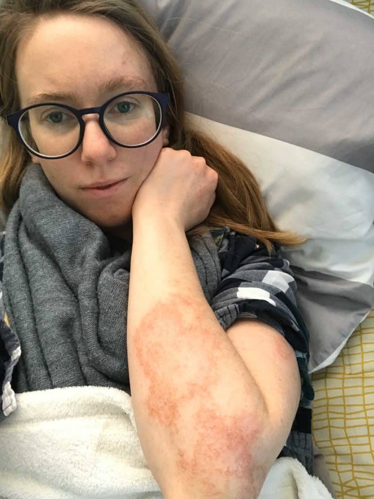 Lumalia laying in bed showing her arm a part of her body covered in rashes from chronic illnesses and how to cope with chronic illnesses